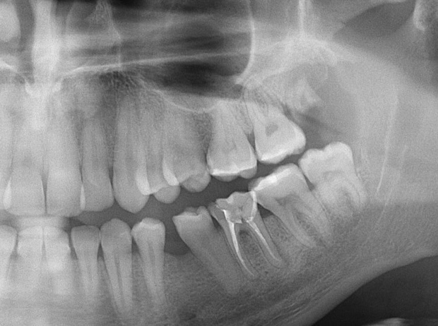 Immagine di Radiografia panoramica che rappresenta un dente del giudizio superiore cariato