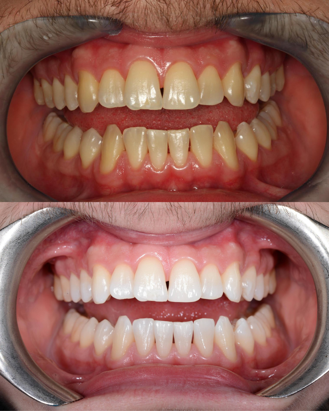 sbiancamento denti prima e dopo