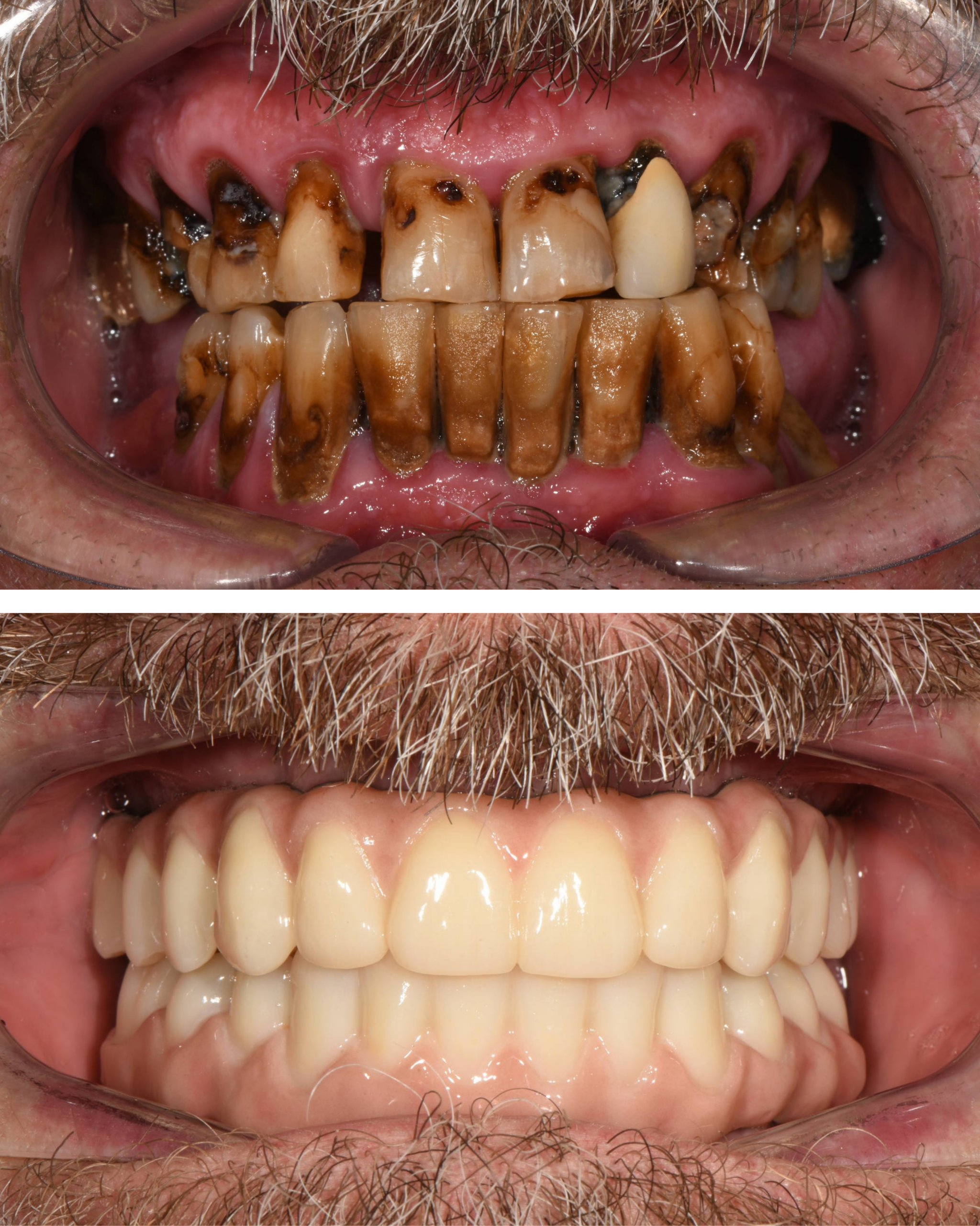 denti fissi in 24 48 ore impianti dentali carico immediato