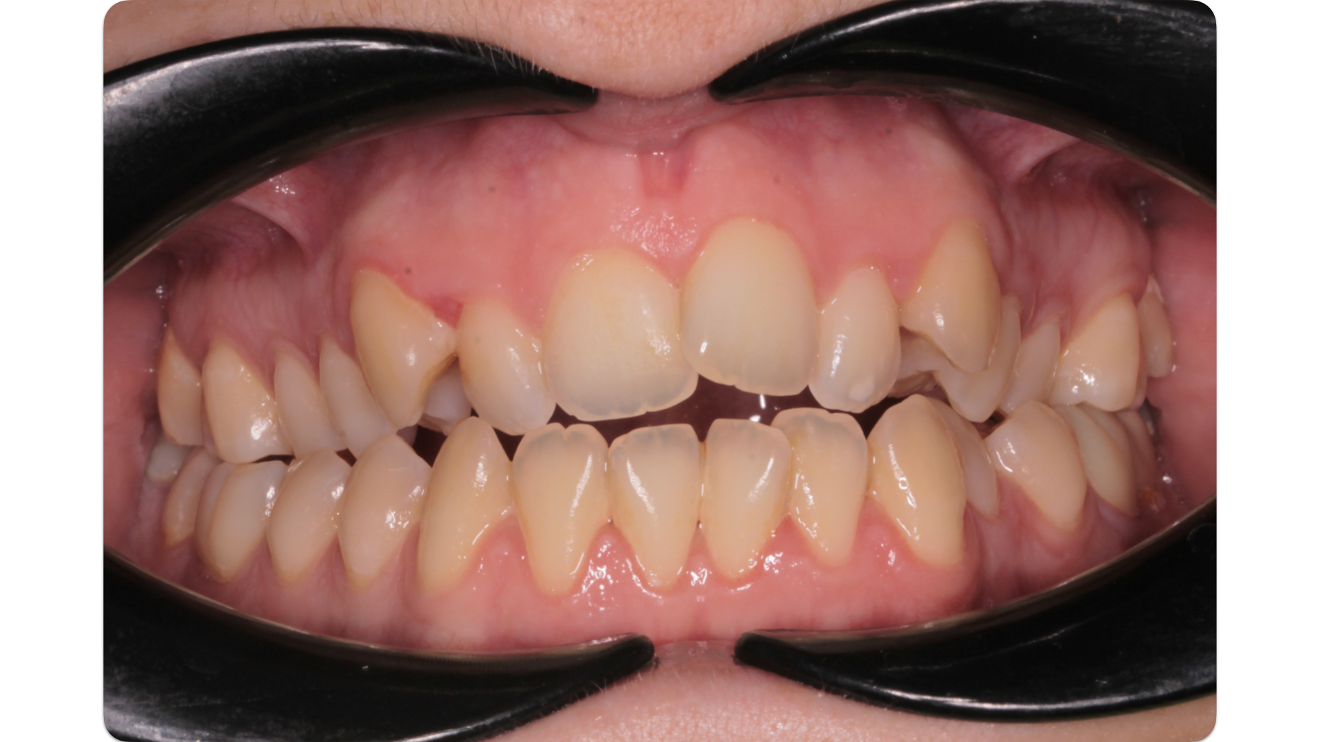 foto di denti disallineati